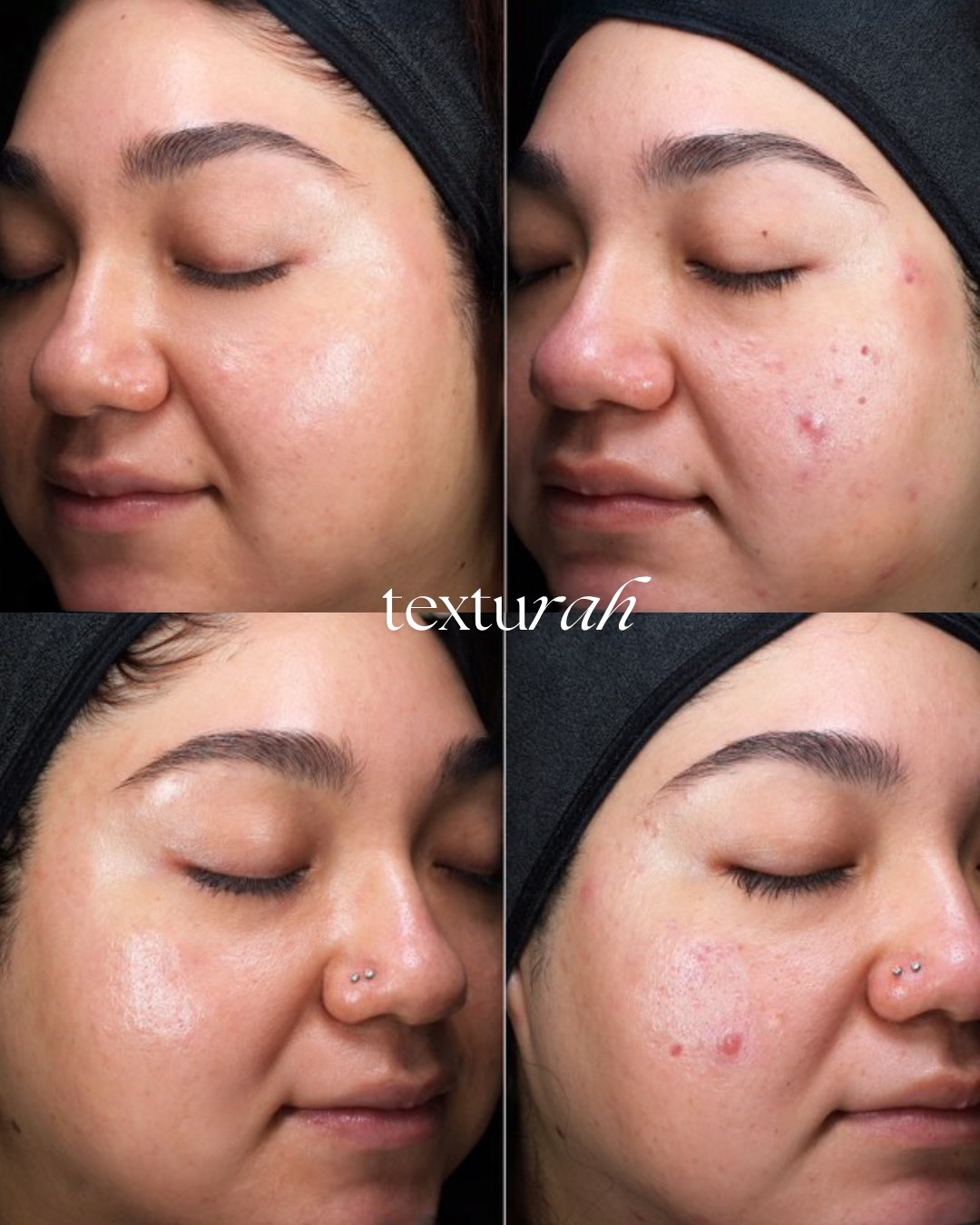Four close up facial skin views showing changes in visible blemishes, redness and overall clarity.